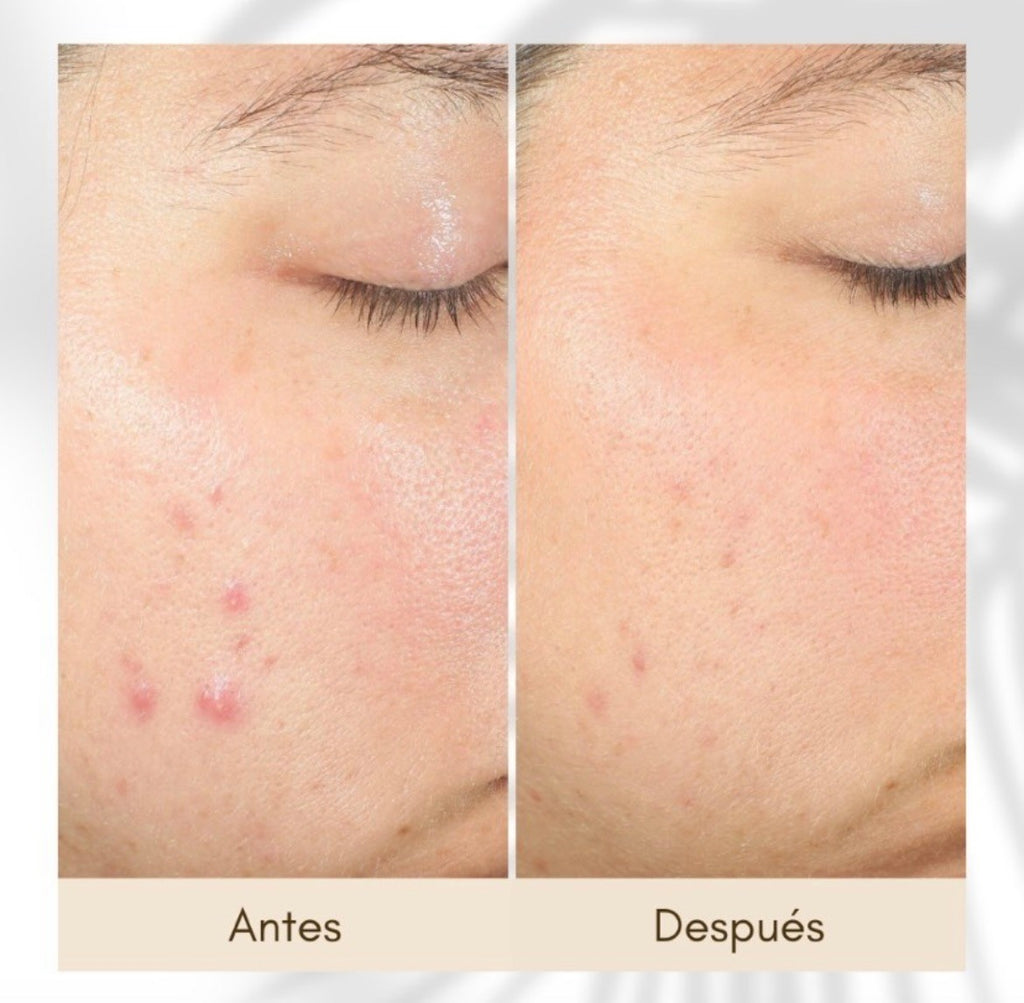 Ácido salicílico al 2% de The Ordinary
