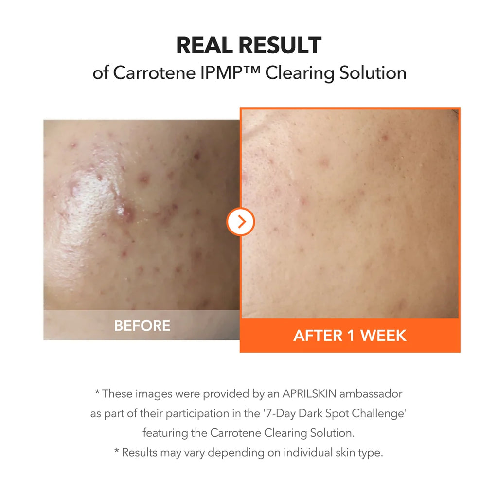 Carrotene IPMP™ Clearing Solution de APRILSKIN